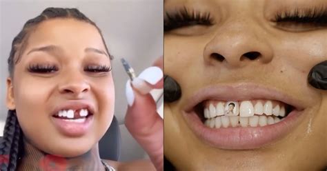 how did chrisean rock lose her tooth|Chrisean Rock Reveals She Is Replacing Her Tooth。